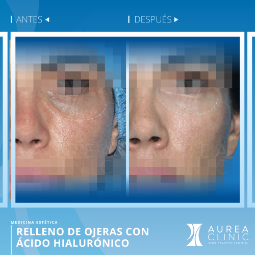 Relleno de Ojeras con �cido Hialur�nico